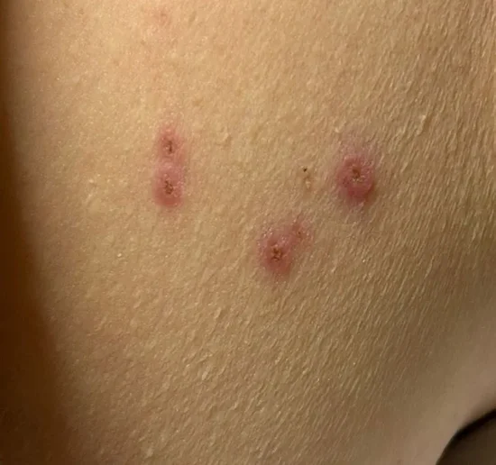 Skin tag removal