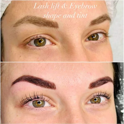 Eyebrow procedure